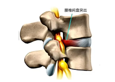 《积极防治骨松合并腰突症，为健康护航》