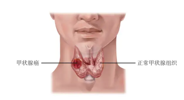 《警惕甲状腺癌年轻化，关注身体变化》