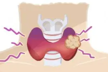 《甲状腺癌术后的饮食之道》