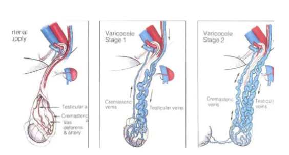 《关注男性生育潜在危险 —— 精索静脉曲张》