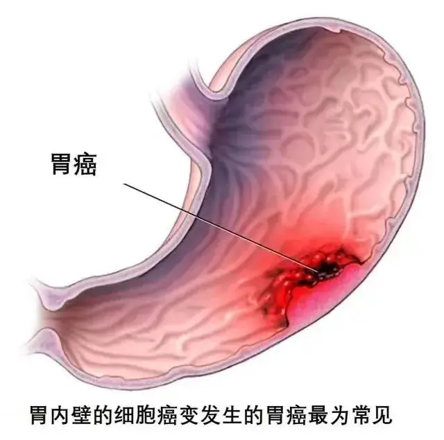 《认识胃癌：症状、》