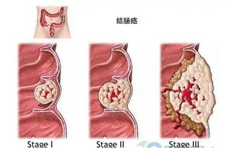 《科学识癌防癌，共筑健康防线》