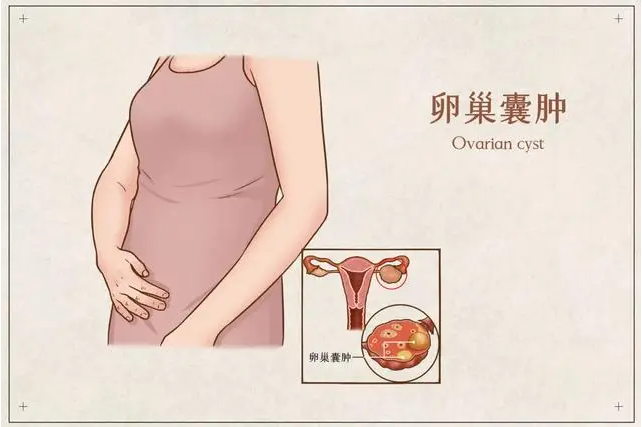 《警惕卵巢囊肿扭转，守护女性健康》 