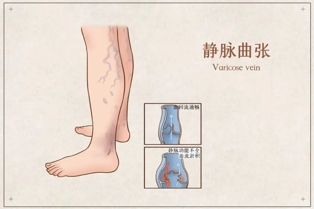 《“瘦腿神器” 的美丽陷阱》